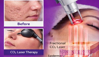 آیا لیزر CO2 می تواند از شر جای جوش خلاص شود؟