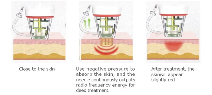 Best RF Microneedling Devices 2025 Best RF Microneedling Devices 2025